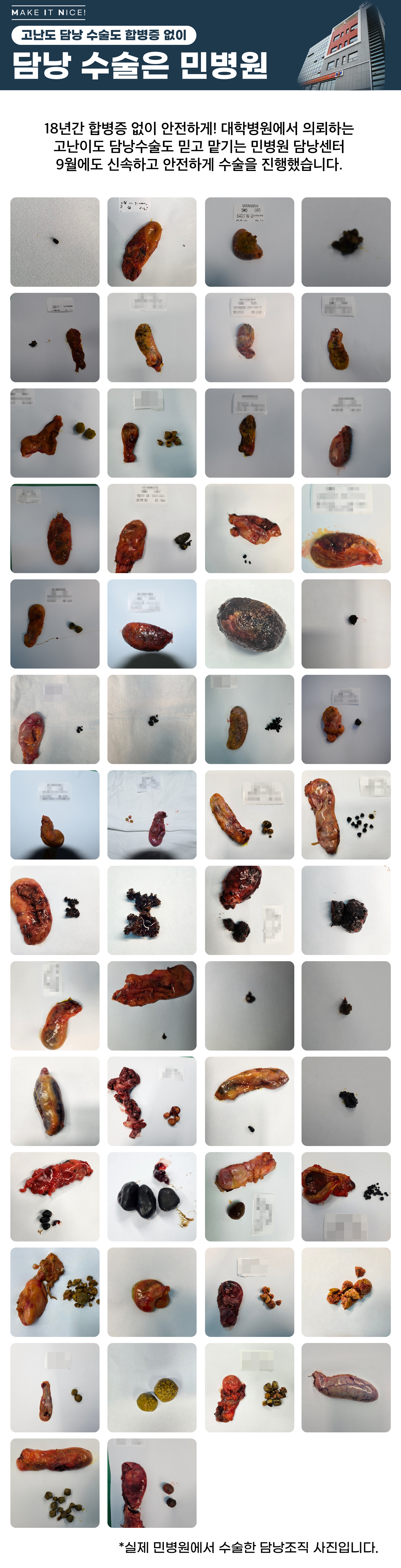 [담낭수술사례] 민병원 9월 담낭수술 후 제거된 조직 사진입니다...