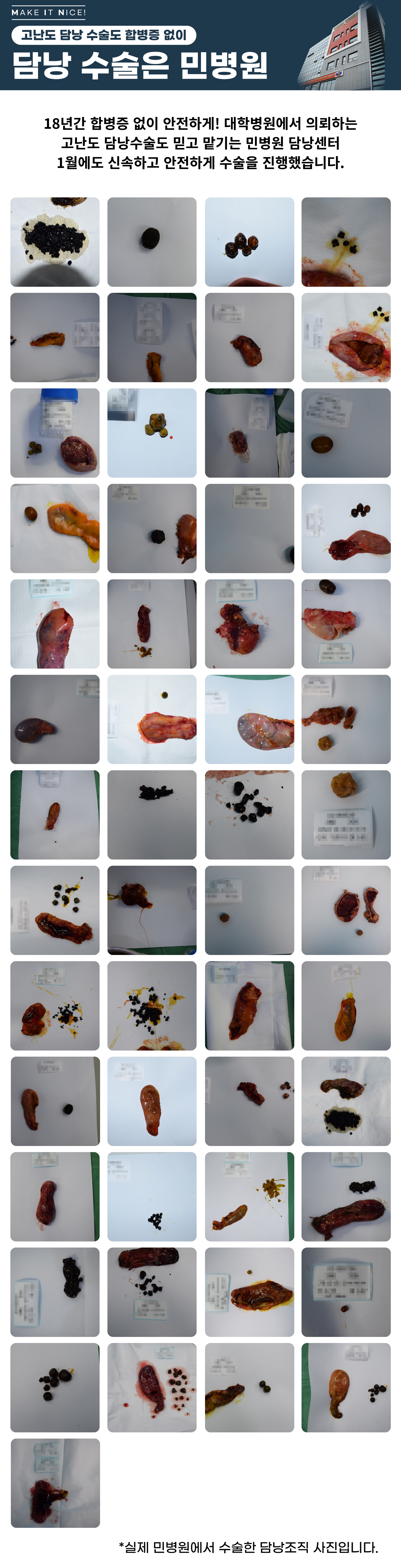 [담낭수술사례] 민병원 26년 1월 담낭수술 후 제거된 조직 사진입니다...