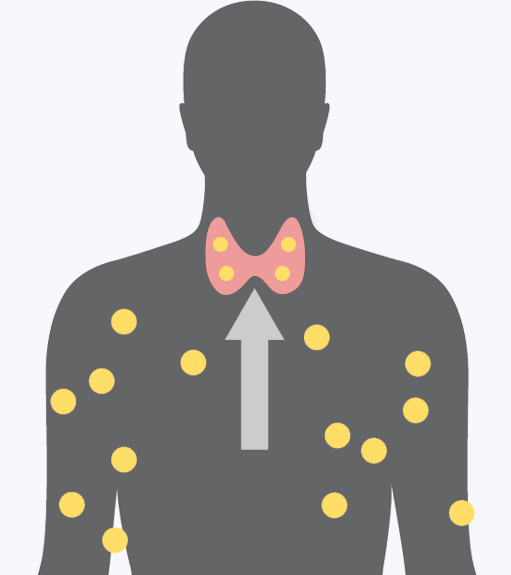 갑상선기능항진증
