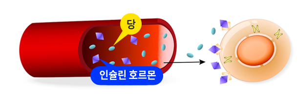 2형 당뇨병(수술가능)