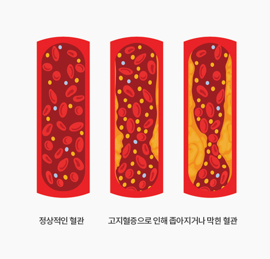 고지혈증이란?