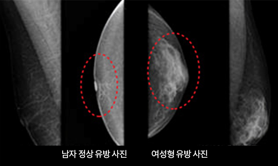 여유증 진단