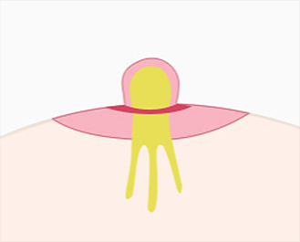 함몰유두 수술법
