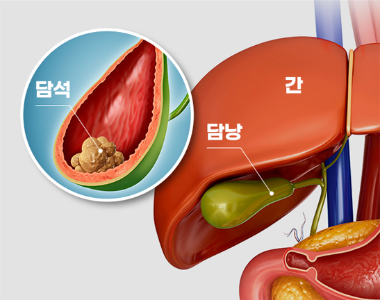 당뇨병이란?