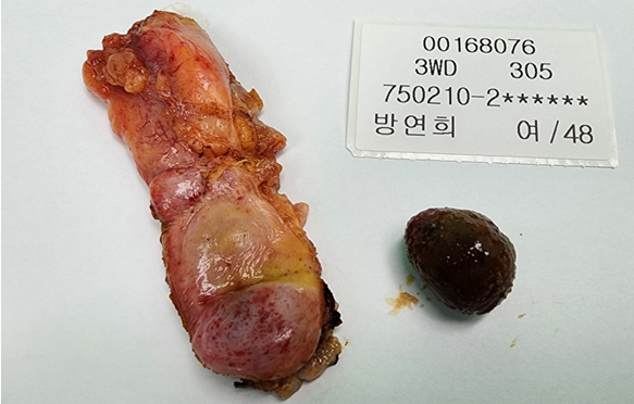 담낭