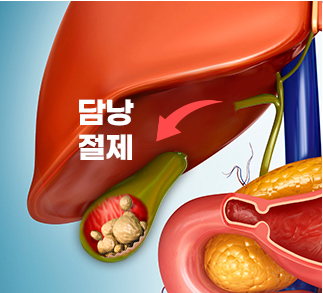 2형 당뇨병(수술가능)