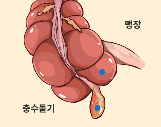 맹장염