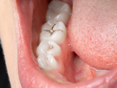 혀 잇몸 구강 점막 암 증상 및 위험 요인