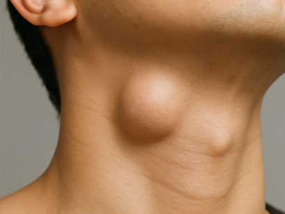 침샘암/경부 전이암