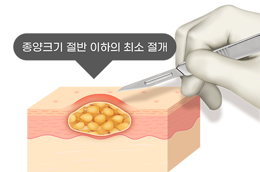 민병원 피부 양성종양센터